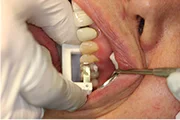 Fig. 4 After adjustment, the crown is cemented, and the excess cement is removed from the interproximal space using the White Serrated Strip.
