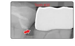 Fig. 1 An improperly seated crown due to overly tight proximal contacts. Crowns like this are often uncomfortable in the mouth and can cause a number of iatrogenic side effects, including the development of dental decay under the crown prematurely.