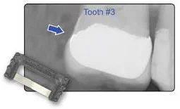 Fig. 2 By using the Black Diamond Strip, proximal contacts were adjusted and Interproximal Relief was restored on this crown on Tooth #3. This ensures that the patient will enjoy the immediate comfort, functionality, and long-lasting quality they deserve.
