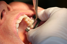 Fig. 1 Using the Black Diamond Strip, the mesial proximal contact is adjusted, and the crown sinks down to rest on the abutment. Because the periodontal membrane on a normal tooth allows for 0.10 mm of lateral movement and the Black Diamond Strip is only 0.07 mm ± 0.02 mm in thickness, the Strip is able to adjust and create perfect proximal contacts.