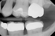 Fig. 2 X-Ray shows the margins seated completely before cementation.