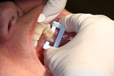 Fig. 3 Cement debris trapped in the interproximal space is removed completely using the White Serrated Strip.