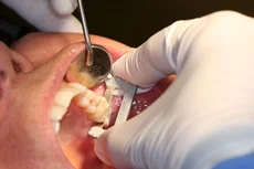 Fig. 4 The proximal surface is polished to a natural finish with the Gray Final Polishing Strip, and Interproximal Relief is confirmed.