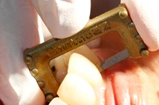 Fig. 1 The unique narrow strip design of the Subgingival Strips makes it easier to access the subgingival area without damaging soft tissues, while the blank central gateway on the Gold Narrow Strip allows for safe and easy insertion into the interproximal space.