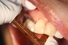 Fig. 2 After removing the overhang, the ultra-fine diamond coating of the Copper Narrow Strip is perfect for polishing the area back to a natural finish.