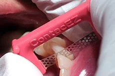 Fig. 1 The Hygienist Strip is perfect for cleaning in areas that are otherwise difficult to access, using stainless steel micro-perforations to remove surface stains and hardened plaque without harming the enamel.
