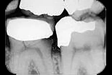 Fig. 2 Subgingival overhangs, often left after the placement of composites or amalgams, easily accumulate plaque and jeopardize the periodontal health of the patient.