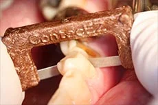 Fig. 4 The Copper Narrow Strip polishes after the removal of an overhang in the interproximal space without causing soft tissue damage.