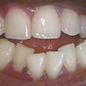 treat_open_bite_small.jpg