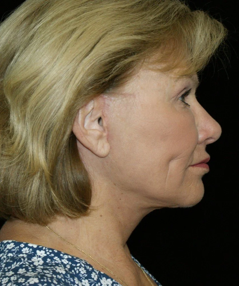 Barb 1 after.jpg
