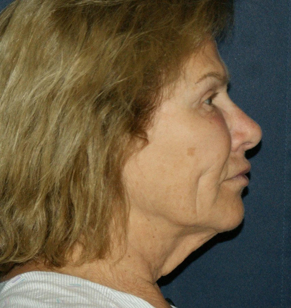 Barb-1-before.jpg