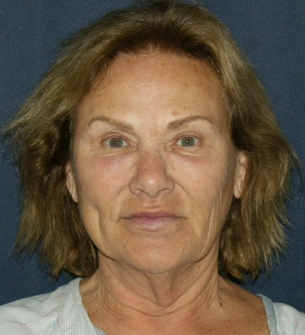 Barb 2 before.jpg