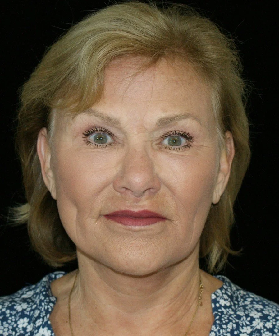 Barb-2 after.jpg