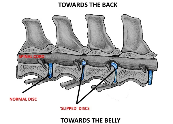What is Intervertebral Disc Disease?