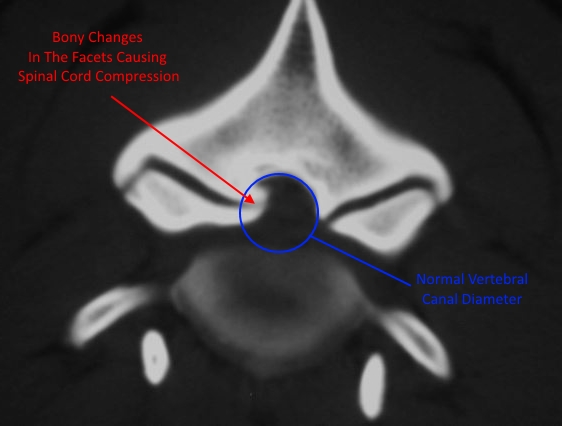 Thickening of the facets can often cause progressive signs in CCSM due to worsening spinal cord compression...
