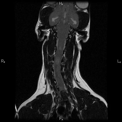 Scoliosis, or a left-right bending malformation f the spinal cord can also happen in cases of COMS and SM