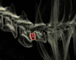 What is Cervical Disc Arthroplasty (CDA)?