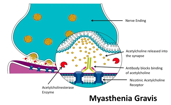 This cartoon depicts the antibody blocking the receptor that leads to the muscle weakness