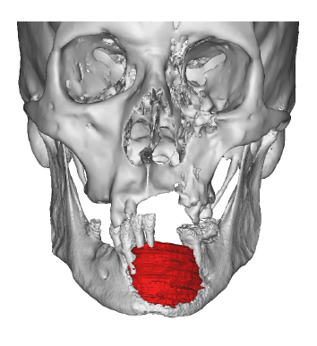 Pre_Planning Tumour.png