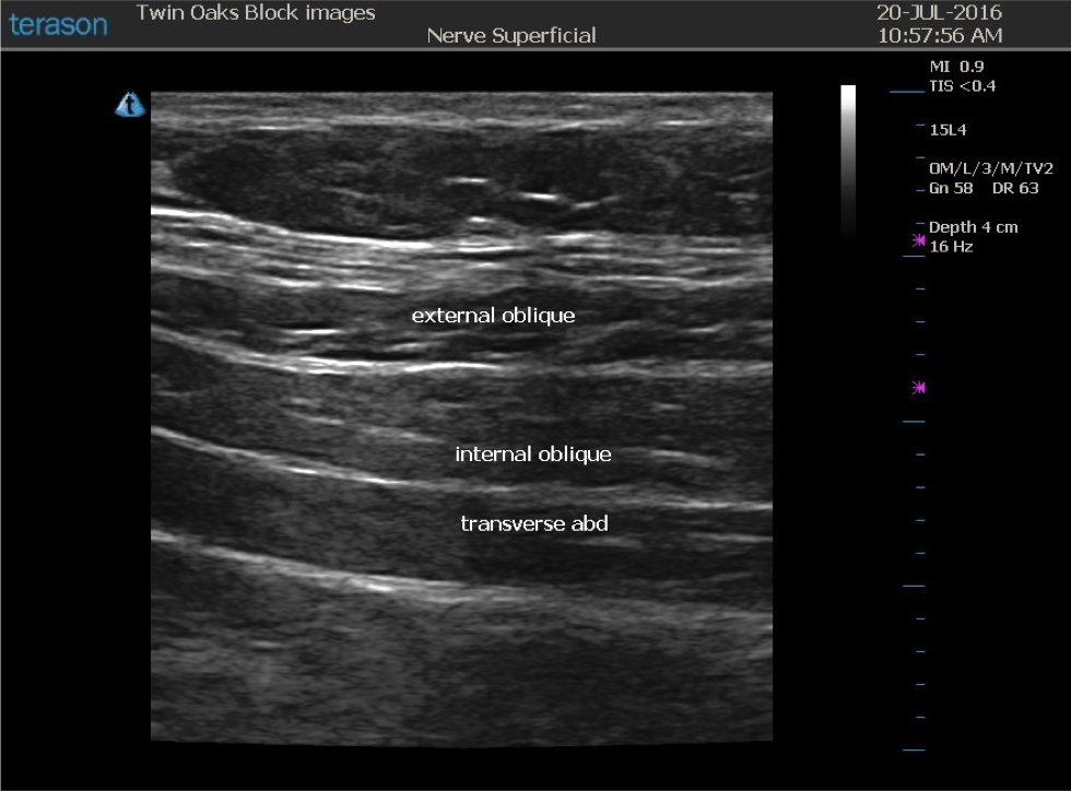 This image shows the sono-anatomy for the peri-umbillical TAP