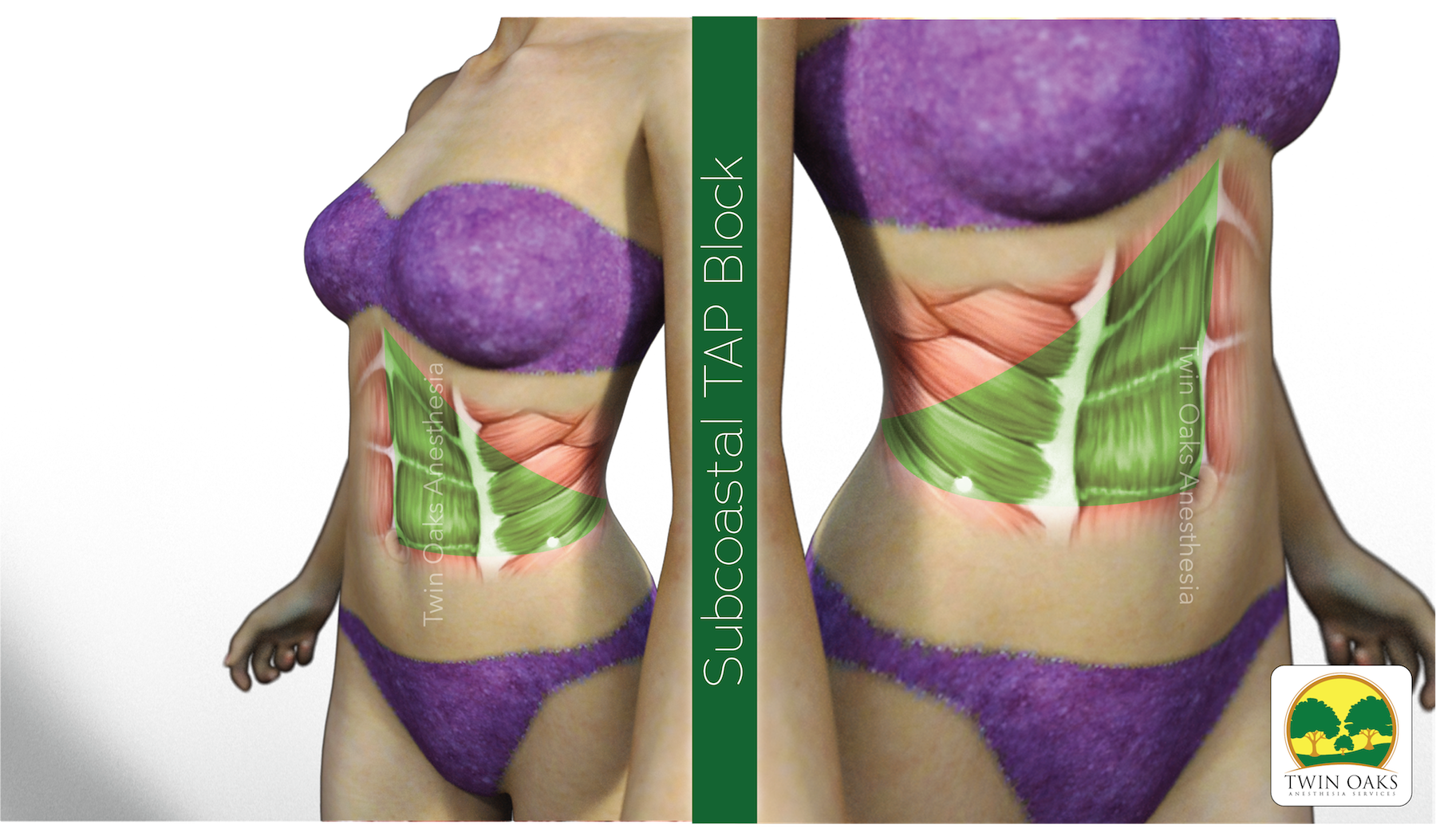 TAP Block — CRNA Conferences Twin Oaks Anesthesia