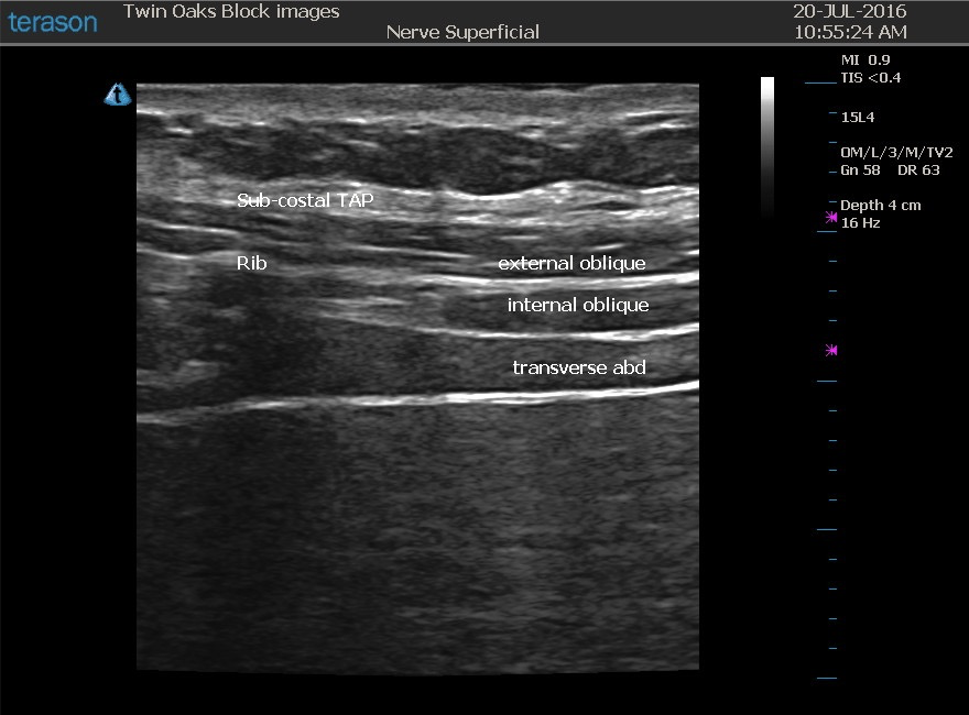 TAP Block — CRNA Conferences Twin Oaks Anesthesia