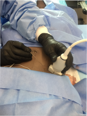 This image shows safe needle position from medial to lateral for this technique.