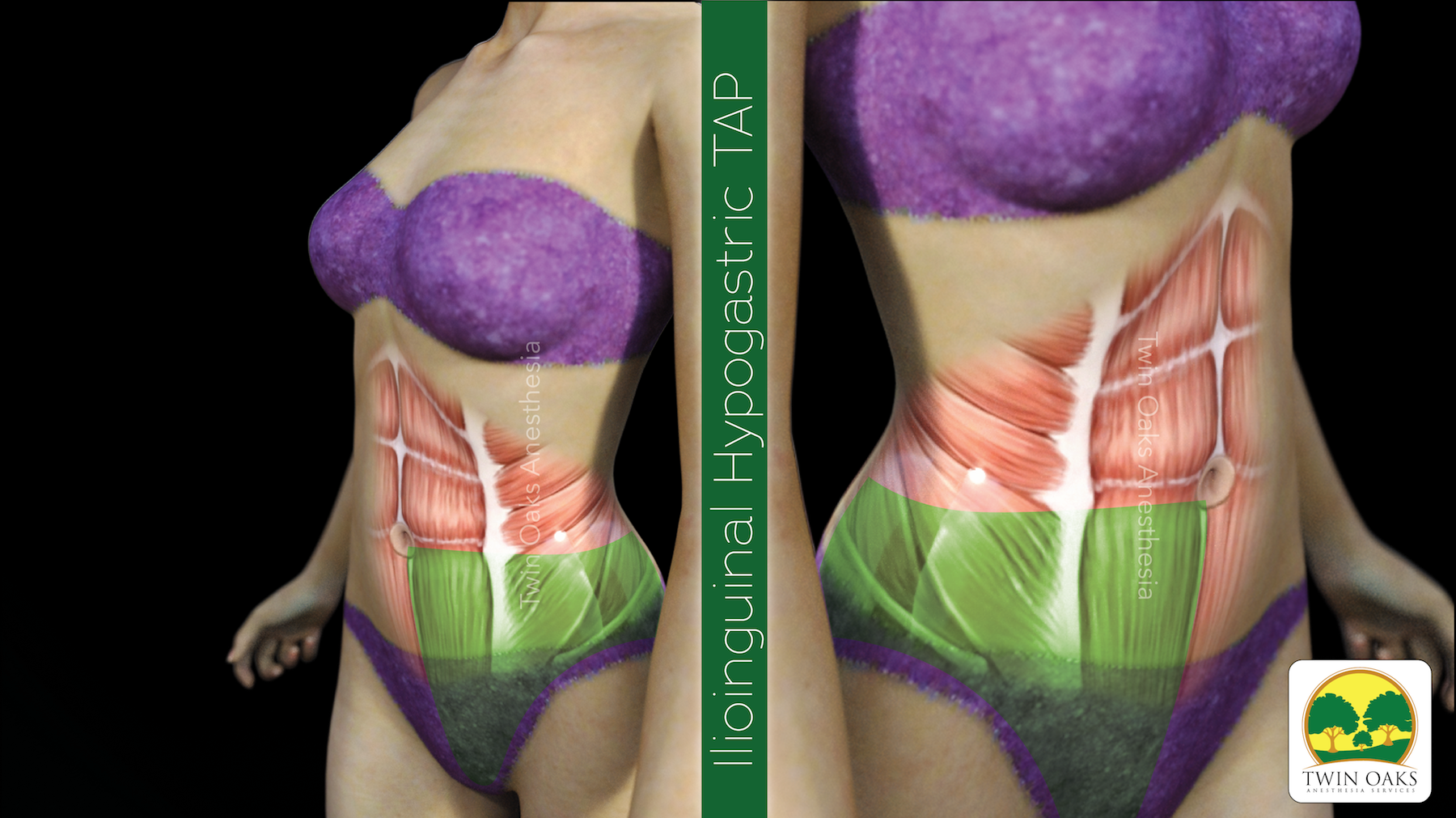 Image for the ilioinguinal/iliohypogastric TAP