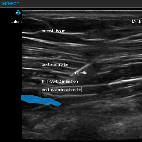 INTRAPEC ultrasound.png