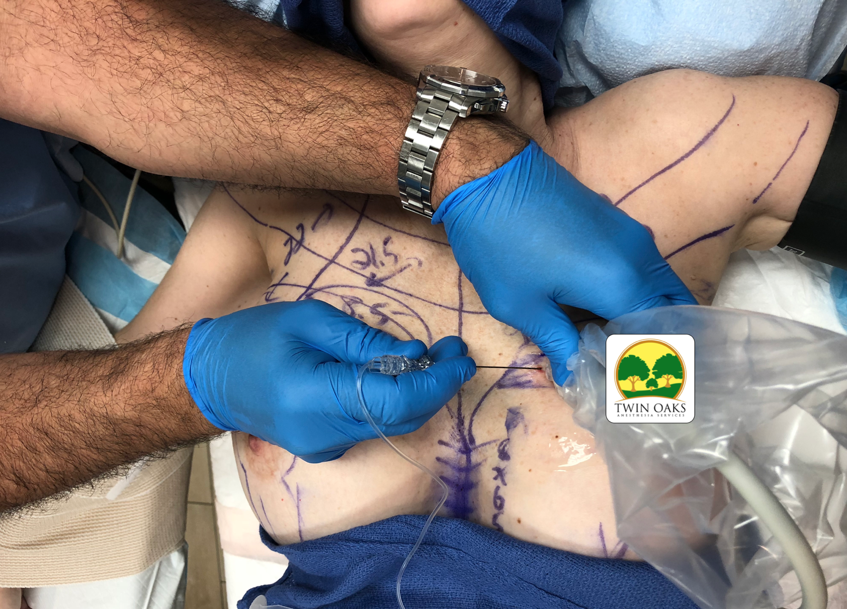 Intrapec ASRA image.png