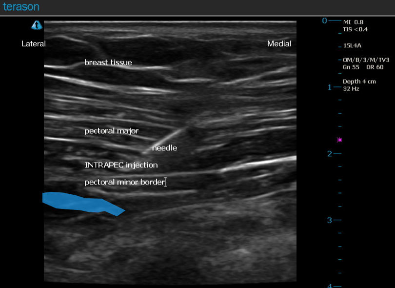 Ultrasound Guided INTRAPEC Injection.png