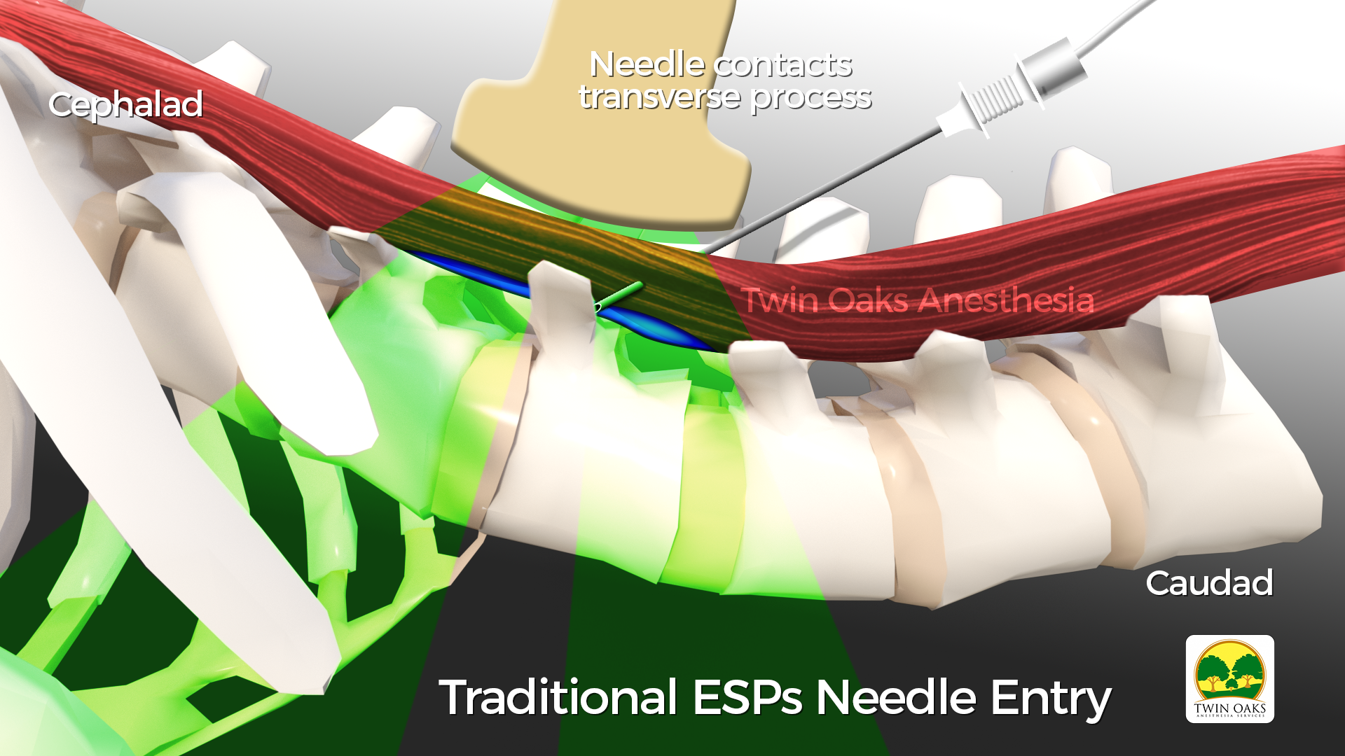 Erector Spinea Block — CRNA Conferences Twin Oaks Anesthesia