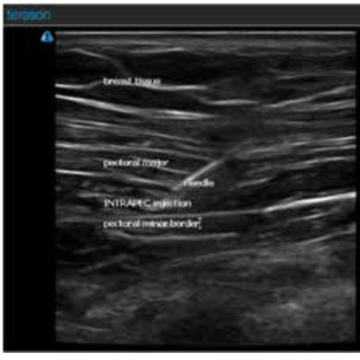 Ultrasound image of the INTRAPEC procedure