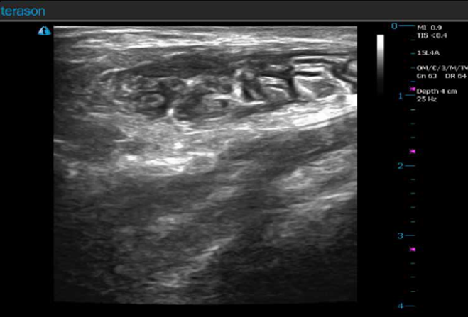 Figure 2. Post left INTRAPEC injection. Note the infiltration and dispersion of local anesthetic solution containing both liposomal bupivacaine and bupivacaine mix. Image courtesy of Jonathan Kline, CRNA, and Twin Oaks Anesthesia.