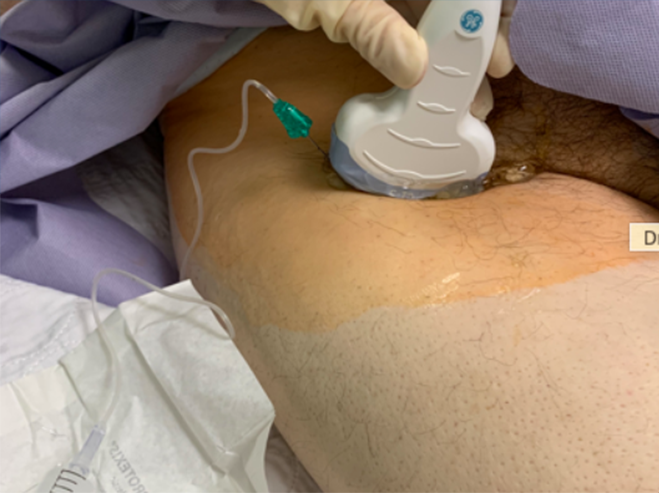 Figure 1. Probe and needle placement for the PENG Block.