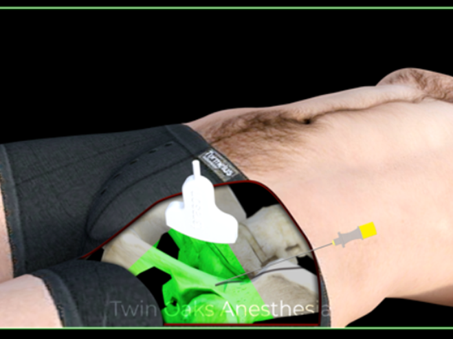 Figure 2. Graphic illustration for probe and needle placement for the PENG block.