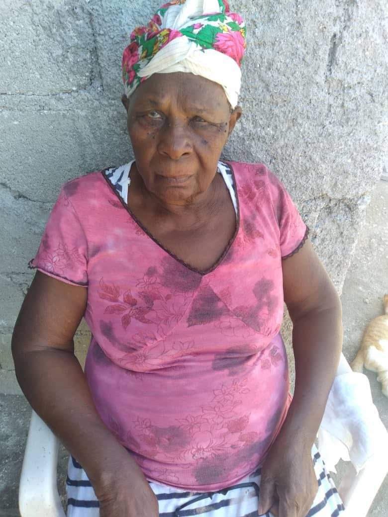 Elderly woman with severe edema in lower legs.