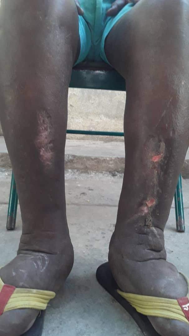 severe edema in lower legs.