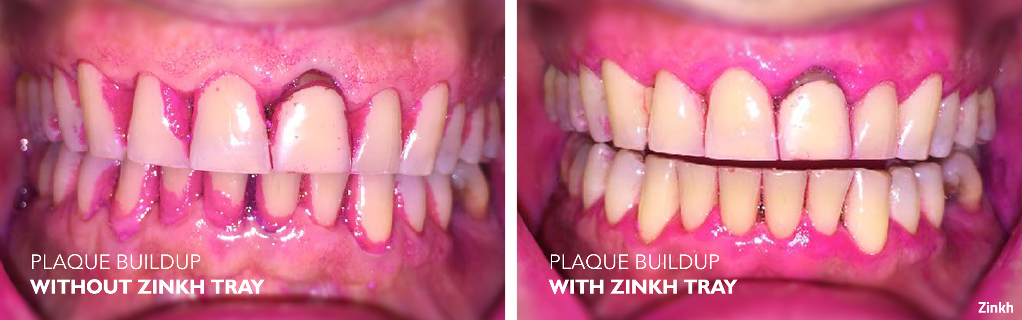 plaque detection test