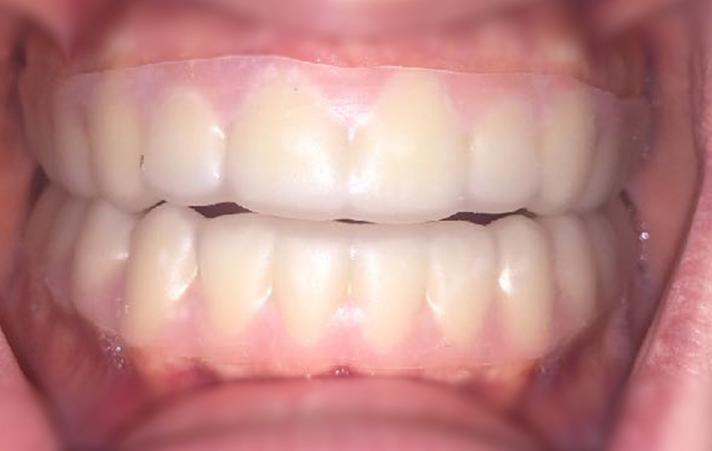 Example of Zinkh dental tray/splint.