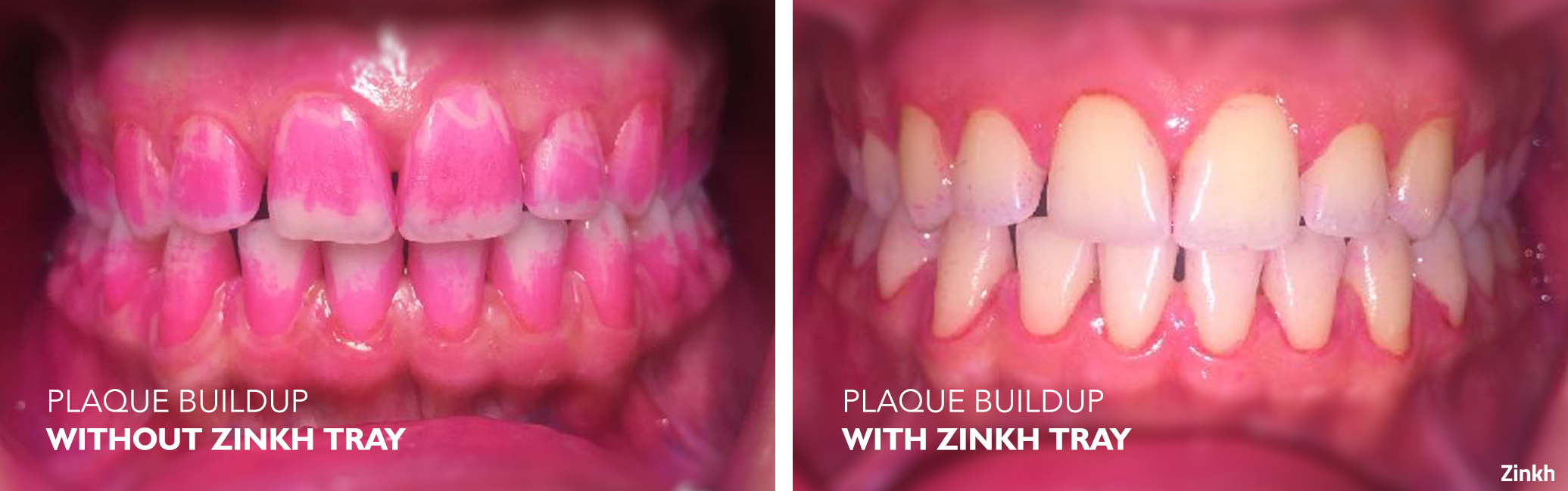 Zinkh-patient-B.png