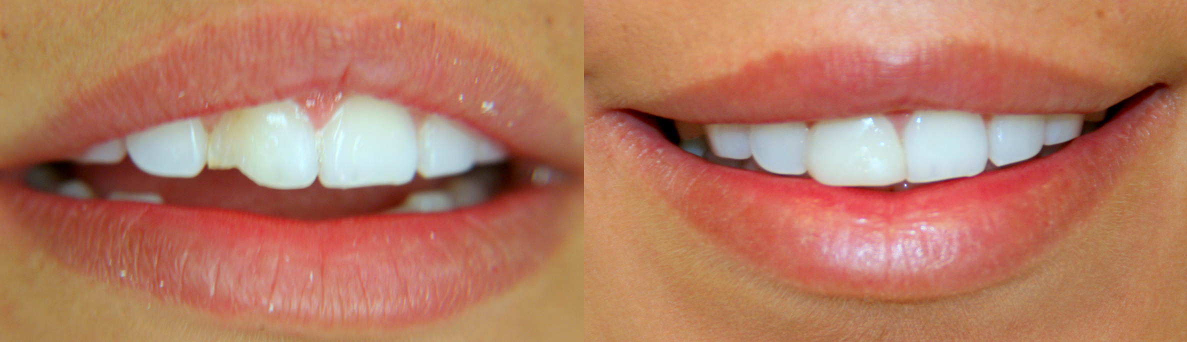 Restoration of chipped tooth with veneers