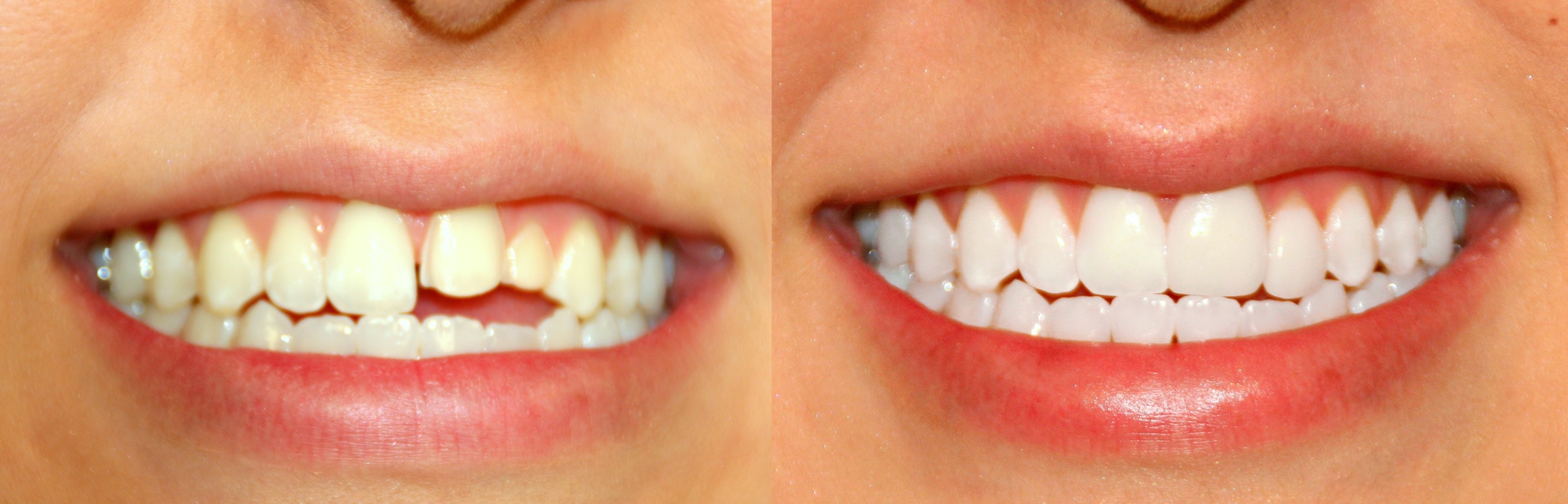 Dr. Ingram closed this patient's gap with veneers.