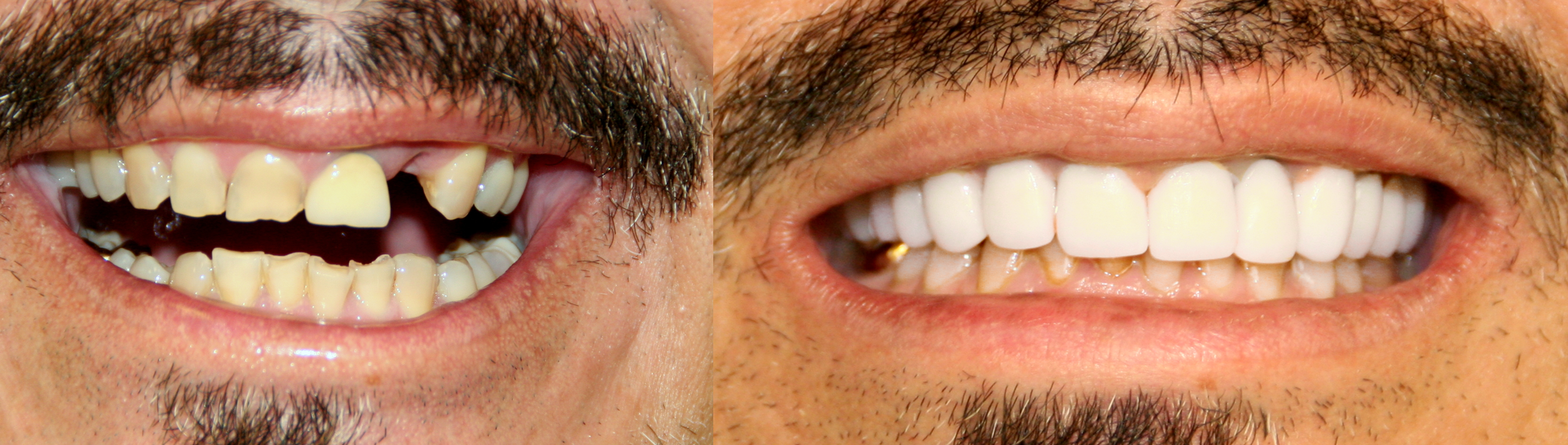  Dr. Ingram restored this patient's upper arch after years of wear and tear. 