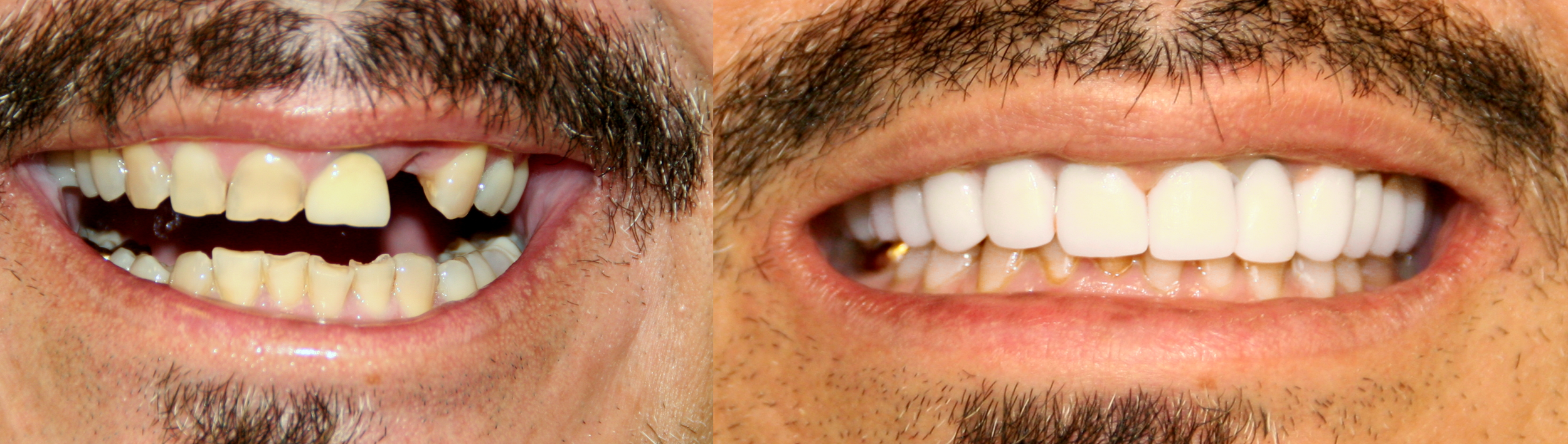 Dr. Ingram restored this patient's upper arch after years of wear and tear.
