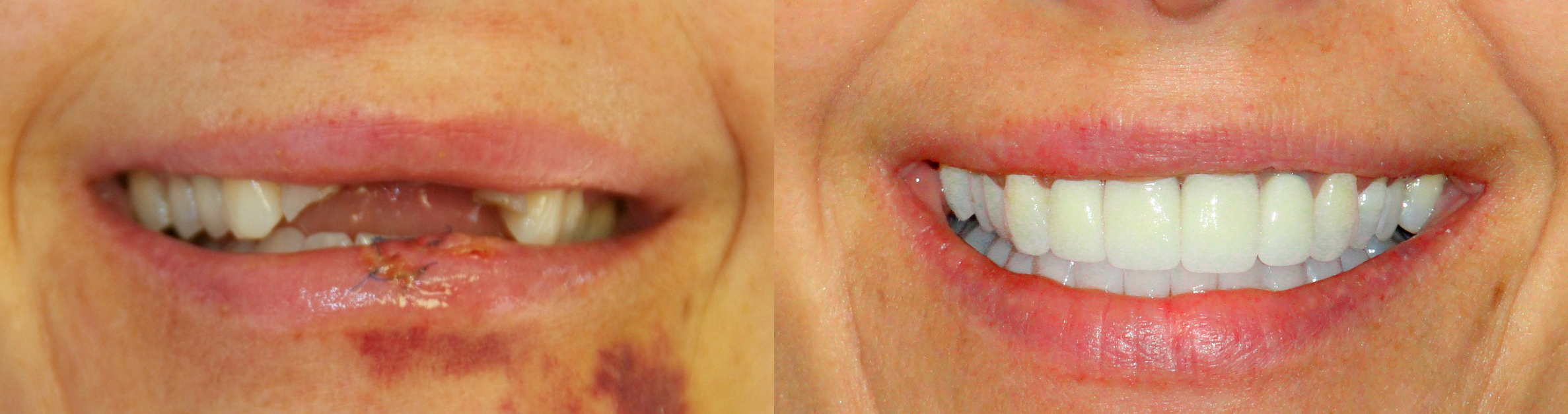 This patient came to Dr. Ingram after an unfortunate accident left her front teeth destroyed.