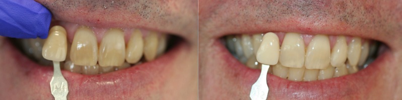  Dr. Ingram only uses the best whitening products from Ultradent— here is a patient going 2 shades brighter after a few weeks with the take-home Opalescence PF system with custom-fitting trays. 