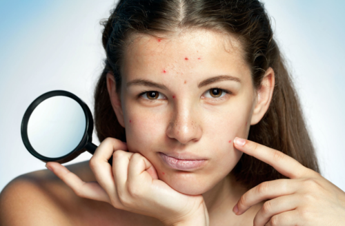 acne+girl.png