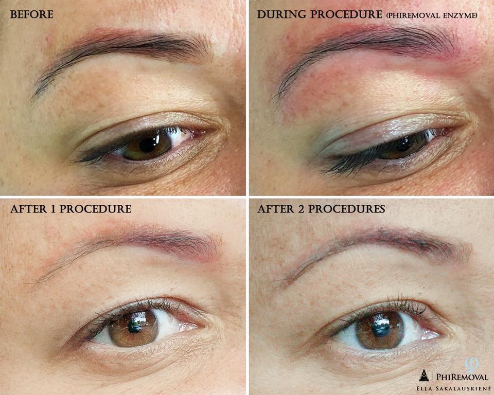 Dermato | Free Full-Text | Laser Removal of Cosmetic Eyebrow Tattoos with a  Picosecond Laser