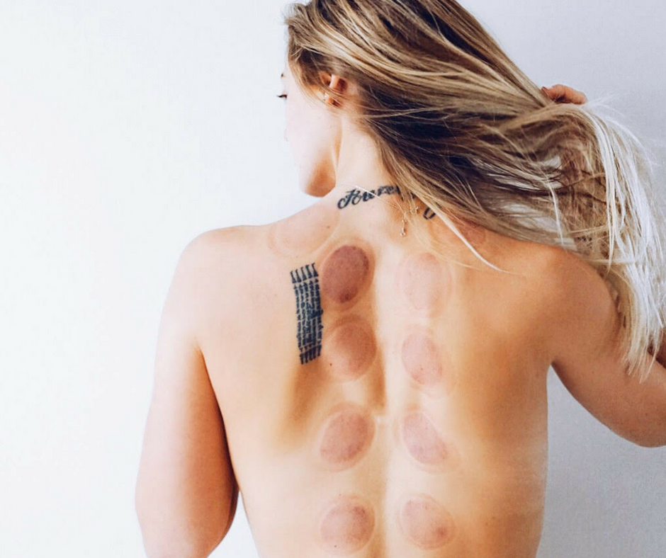 FIND OUT WHY I PUT CUPPING IN THE GIRL TALK SECTION ;)